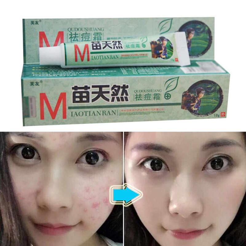 1 Pc Natural Germicidal Removel Cream Mite Moisturize Skin Cream Original Remove Acne Cream Ointment